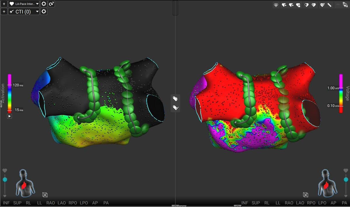 Two views of a left atrial electroanatomical map. The left panel shows an activation map; the right panel shows a voltage map. Both display chains of ablation lesions encircling the pulmonary veins.