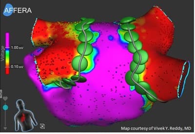 A voltage map of the left atrium showing low-amplitude scar in magenta where ablation lesions encircle the pulmonary veins.