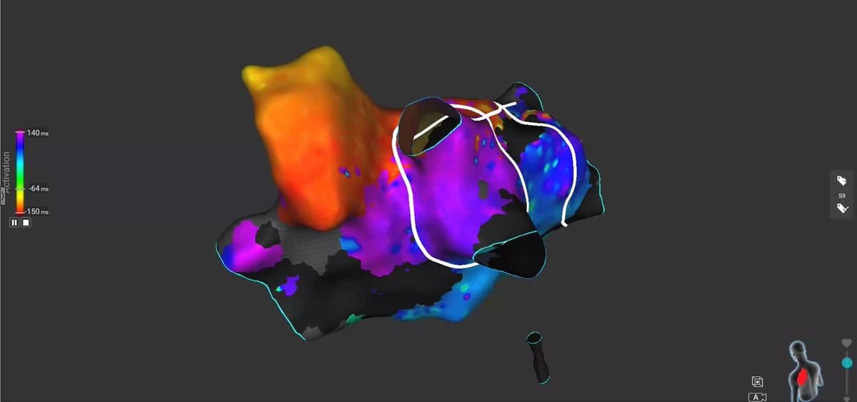 An activation map of the left atrium on the Affera system, coloured from orange through purple to blue, with continuous white lines encircling both sets of pulmonary veins where ablation lesions have been placed.