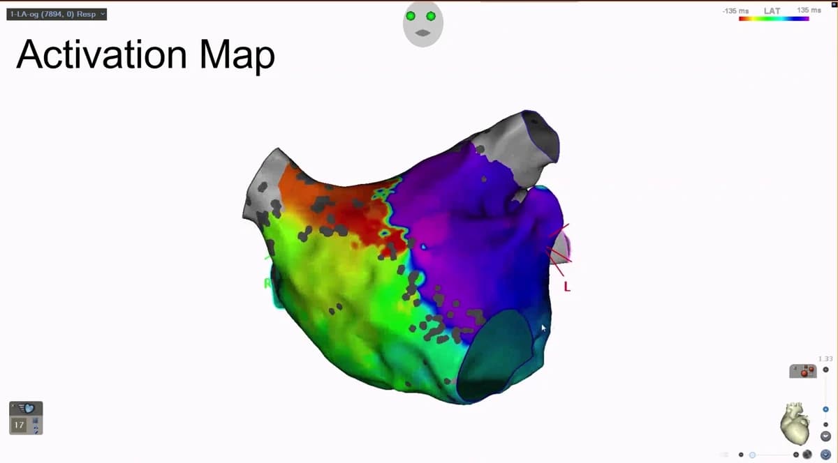 An activation map of the left atrium on the CARTO 3 system, coloured from red through the spectrum to purple to show the order in which regions of the chamber are electrically activated.