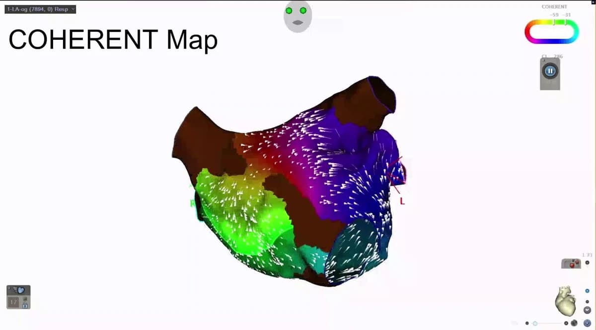 A CARTO 3 COHERENT map of the left atrium with white arrows across the surface indicating the direction and speed of electrical conduction.