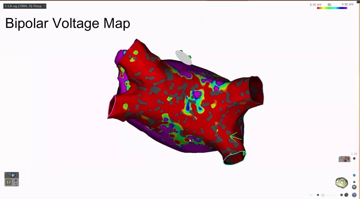 A bipolar voltage map of the left atrium on the CARTO 3 system. Most of the surface is red, marking low-amplitude tissue, with purple areas of preserved signal and scattered grey gaps where no point was taken.